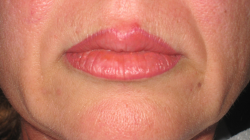 After Picture (lips)