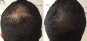 Hair Restoration (Before & After)